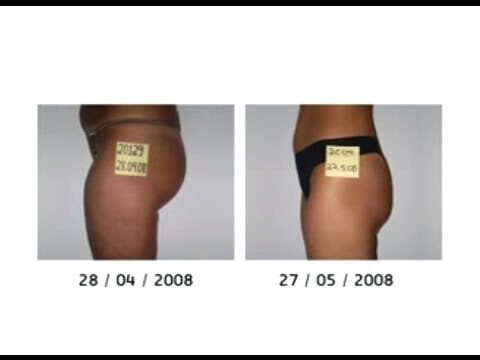 Lipoaspira&ccedil;&atilde;o N&atilde;o Invasiva: Pre&ccedil;os em Lisboa