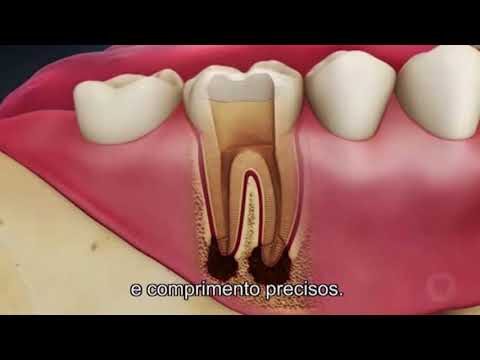 Preço para Desvitalização de Dente: Guia Completo