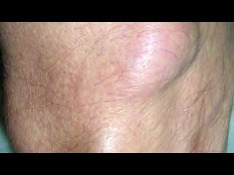 Receber baixa após cirurgia ambulatorial: o que esperar